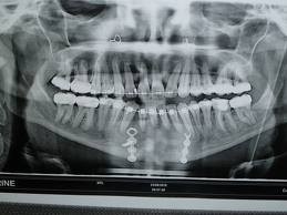 Panoramique dentaire, numérisé dentaire, radiologie dentaire
