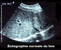 Echographie abdominale, Echographie pelvienne, Echographie urinaire
