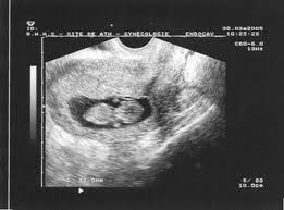 Echographie naissance, écho de grossesse ( datation ), cabinet cohen